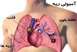 آمبولی‌ ریه‌ مانع خون‌رسانی به ریه می‌شود