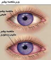 بیماری CVS چشم در اثر کار با کامپیوتر