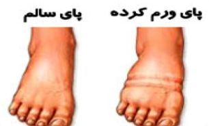 چه موقعی ورم پا جدی می شود؟