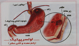 خودسرانه داروی معده مصرف نکنید