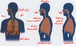 چه زمانی سکسکه را جدی بگیریم؟