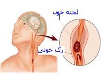 با علایم سکته مغزی آشنا شوید