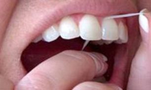 استفاده نکردن از نخ دندان عامل مهم شکسته شدن دندانها
