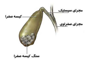 با سنگ آزاردهنده کیسه صفرا چه کنیم؟