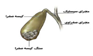 سنگ کیسه صفرا در چه کسانی شایع‌تر است؟