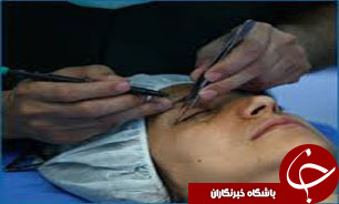 چه کسانی باید جراحی پلک انجام دهند؟
