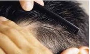 برای معالجه ریزش مو این نسخه فوق العاده را بخوانید + عکس
