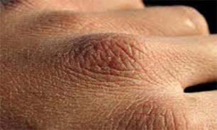 نکاتی درباره تزریق چربی جهت رفع چین و چروک پشت دست