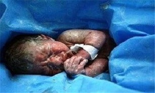 دختر هنگ‌کنگی با دو بچه در شکم به‌دنیا آمد