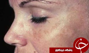 این عامل انسان را 5 سال زودتر پیر می‌کند