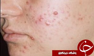 آمار ترسناک از بیماری‌های روانی به خاطر جوش صورت در انگلیس
