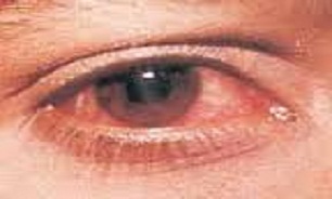 قرمزی چشم را ساده نگیرید