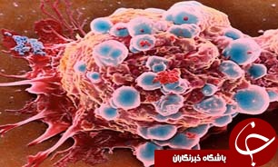 اغلب عوامل خطر سرطان کولون قابل تغییر هستند