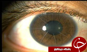 تغییرات قرنیه چشم باعث این بیماری می‌شود