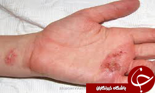 اگزما را به راحتی در خانه درمان کنید