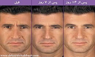 "بوتاکس" هم به حراج گذاشته شد!