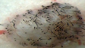 گام نخست درمان کچلی با سلول های بنیادی
