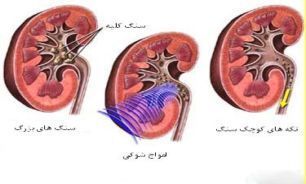 با مصرف فراوان آب از ایجاد کیست کلیه جلوگیری کنید
