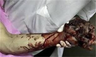 هشدار درباره سوختگی با مواد محترقه در شب چهارشنبه سوری