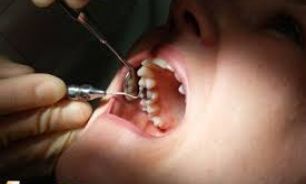 علل لق شدن دندان و راههای رهایی از این معضل بزرگ