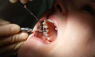 دندانی که کمبود فضا باعث نهفته شدن آن می‌شود