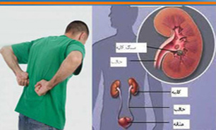 «سنگ کلیه» در 90 درصد موارد قابل پیشگیری است