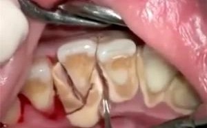 نتیجه 10سال مسواک نکردن دندان‌ها +عکس