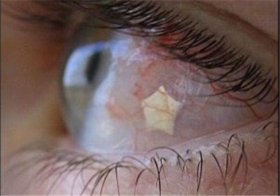 کاشت نگین ۷میلیونی در چشم دغدغه جدید میلیونرهای تهرانی