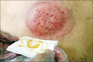 جمع آوری دیدگاه های ابن سینا درباره حجامت
