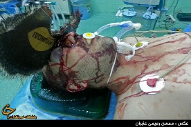 خارج کردن سنگ فرز ساختمانی از داخل جمجمه کارگرمشهدي +تصاویر اختصاصی