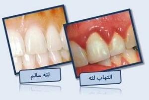 این بیماری خطرناک باعث التهاب لثه ها می شود