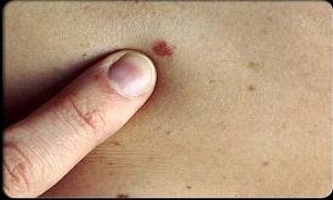 عجیب ترین علامت سرطانی که خانم ها نباید نادیده بگیرند!
