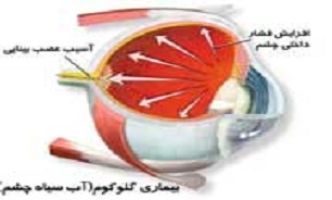آفتاب و گرد و خاک عوامل اصلی ایجاد ناخنک