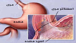 تحرک نداشتن مهمترین عامل در شیوع ریفلاکس معده