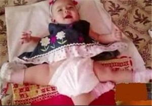 دختربچه‌ای که با ۳ پا زندگی می‌کرد