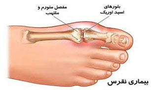 چند توصیه ساده برای اینکه دچار "حمله نقرسی" نشوید