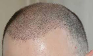 اولین قرص ضد طاسی دنیا رونمایی شد + تصاویر