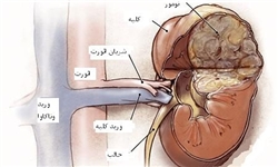سرطان کلیه، کشنده‌ترین بیماری دستگاه ادراری/ مردان در معرض خطر بیشتری قرار دارند