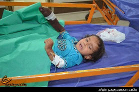 سهل انگاری والدین سبب قطع انگشت کودک 19 ماهه شد+تصاویر اختصاصی