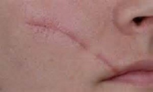 جای زخم بر روی پوست های سبزه بیشتر می ماند