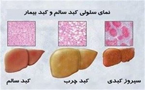 برای پیشگیری از کبد چرب حتما این نکات را رعایت کنید