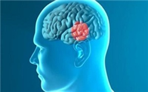 دانستنی های جالب در مورد این بیماری مغزی