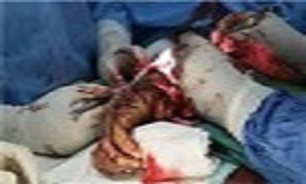 بعدازعمل جراحی گازاستریل در بدن مادرجاماند