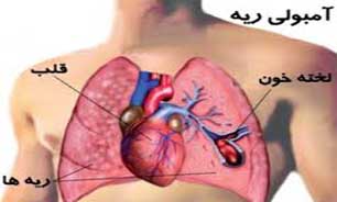 بی توجهی به درد ساق پا موجب آمبولی ریه می‌شود