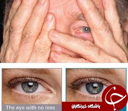 لنزی که چهره را جوان‌تر می‌کند