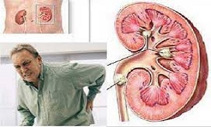 رژیم غذایی دارای کلسیم زیاد خطر سنگ کلیه را تا سه برابر افزایش می‌دهد