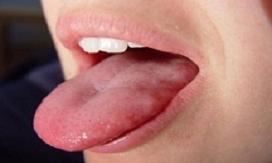 "سندرم سوزش دهان" چیست؟