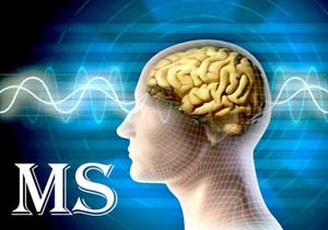 ویتامین D ناجی MS