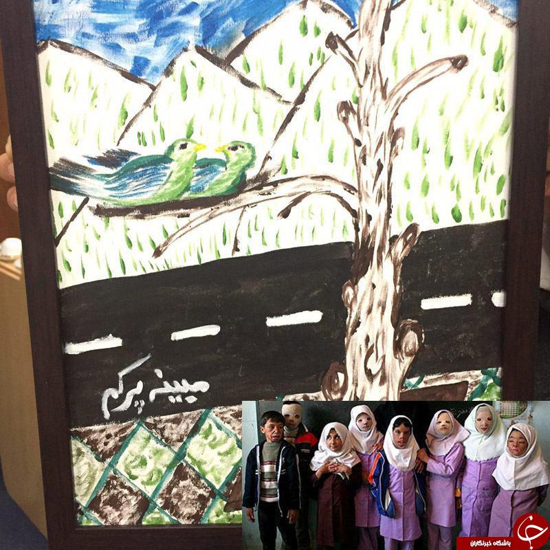 دستان سوخته ای که پس از درمان توان نقاشی پیدا کرد+ تصاویر