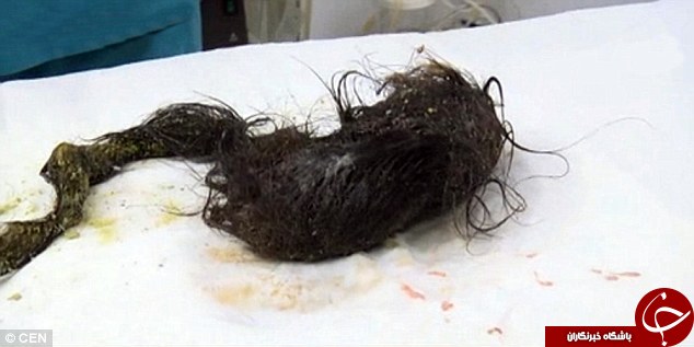 معده و روده این کودک قزاقستانی مملو از موی سر است + تصاویر